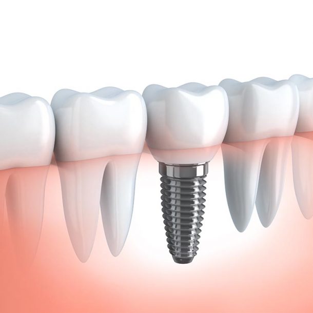 Zęby z implantem Gabinet stomatologiczny Dr Frank - Warszawa Mokotów